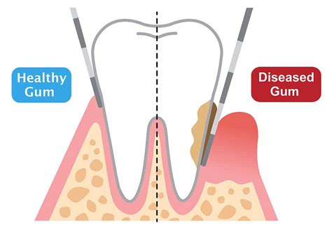 Periodontal Surgery/Pocket Depth Reduction | Periodontal Procedures