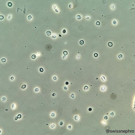 Glomerular hematuria with >60% dysmorphic RBCs in a patient with suspected infection. (Phase ...