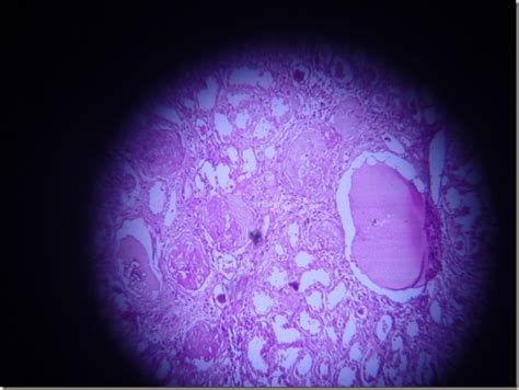 Histology Slides Database: Chronic Pyelonephritis histopathology