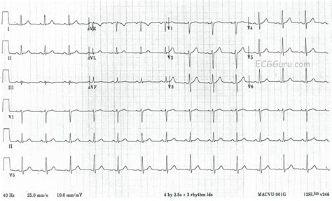 ECG Interpretation: ECG Blog #124 - Teaching by Using a Normal ECG (ECG Guru)