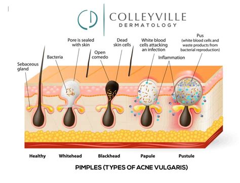 Pediatric Dermatology - Colleyville Dermatology