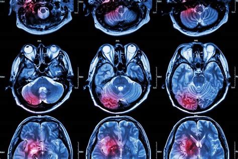 SSA Listing 11.05 for Benign Brain Tumors