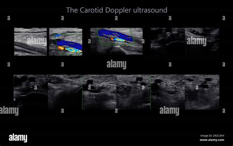 A Carotid Artery Doppler Ultrasound Is A Diagnostic Test, 47% OFF