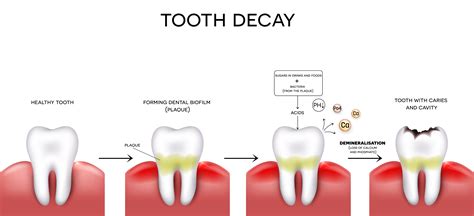 Dental Filling - .: Sunshine Dental