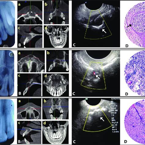 (I) Periapical cyst: (A) IOPA radiograph, (B) (a-d) CBCT views (c)... | Download Scientific Diagram