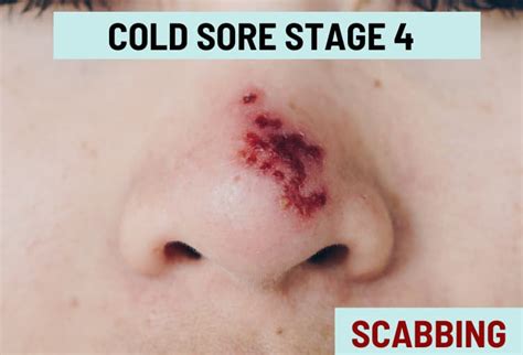 Cold Sore Stages, with Pictures