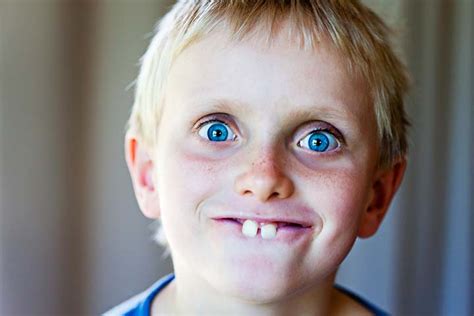 Buck Teeth In Kids: Causes, Health Risks, Pictures & More