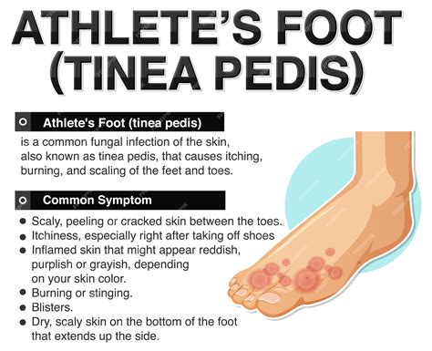 Athlete's Foot Fungus Types and Effective Remedies - Feet Relief