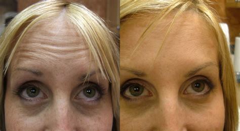 Wrinkle Treatment Before and After: Botox, Dermal Fillers