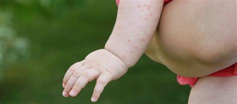 Baby Heat Rash: Symptoms, Prevention, and Treatment | Pampers