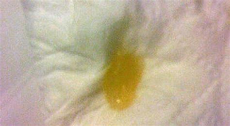 Coughing Up Yellow Mucus from Chest, in the Morning, Meaning, Treatment – Treat, Cure Fast