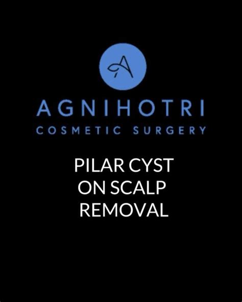 Check out this Pilar Cyst on the scalp that Dr. Agnihotri removed ...