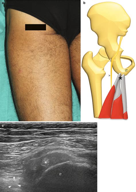 The Hip: Focused Ultrasound Anatomy and Examination Technique | Radiology Key