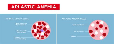 Aplastic Anemia Overview Causes Symptoms Treatment Illness Com | SexiezPix Web Porn