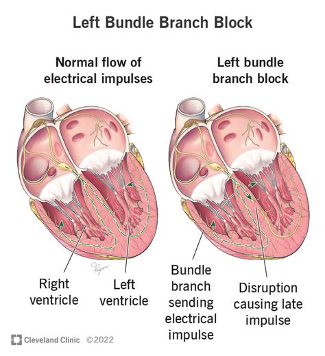 Left Bundle Branch Block: Causes, Symptoms & Treatment