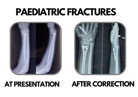 Paediatric Fractures :: Dr Deepak khurana- Paediatric Orthopaedic Surgeon