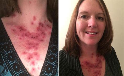 Skin cancer symptoms: Spots on mum's on wedding day turned out to be ...