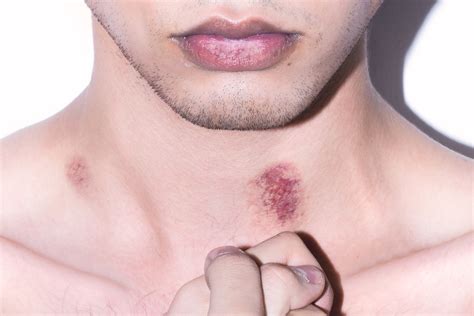 How to get rid of a hickey, if you somehow are still getting hickeys | British GQ | British GQ