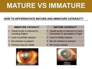 Cataract | PPT