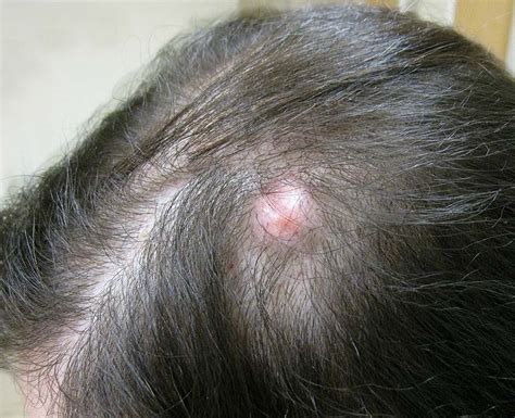 Pilar Cyst: Causes, Removal & What it Is