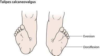 Peds: Talipes Calcaneovalgus Flashcards | Quizlet