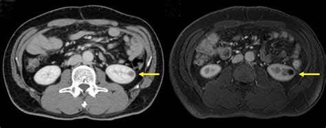 Imaging findings of the kidney. (A) Contrast enhanced computed... | Download Scientific Diagram