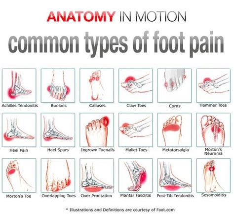 Common types of foot pain - Advance European Medicare Center