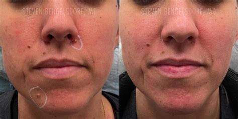 Mole Removal Before and Afters | Franklin Skin and Laser