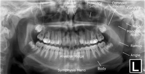 Dental Panoramic Tomogram (OPG) – prestige-dental-care.com.my