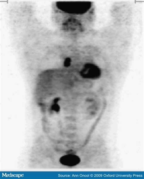 Lymphoma: Pet Scan Lymphoma