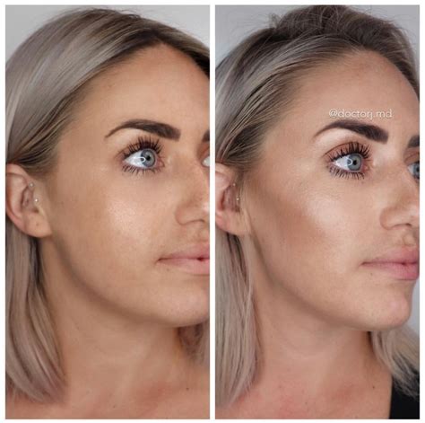 My Experience With Dermal Fillers. | allypintucci.com