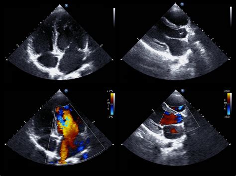 Pulmonary Hypertension Detection Aided By Non-invasive Doppler Echocardiography in New Study