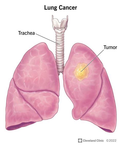 Lung Cancer: Types, Stages, Symptoms, Diagnosis & Treatment