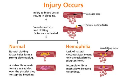 HAEMOPHILIA | MetroHealth HMO