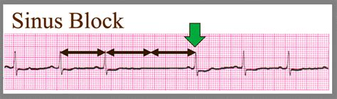 SA Block and Sinus Arrest