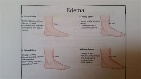 Pitting Edema Levels