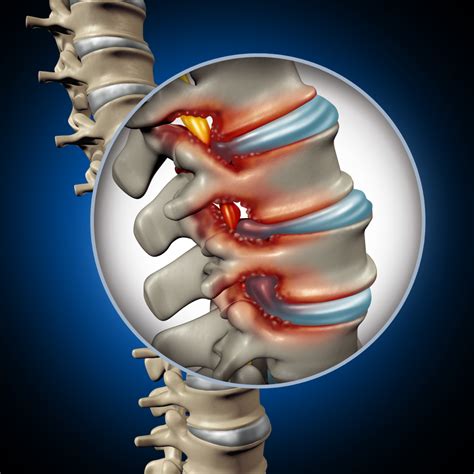 Lumbar Disc Herniation | Orthopedic Institute of Sioux Falls