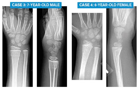 Emergency Medicine Pearls, Pitfalls for Treatment of Pediatric Distal ...