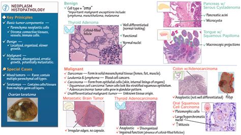 Histology: Neoplasm Histopathology | ditki medical & biological sciences