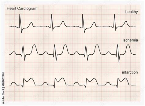 Heart Rhythm Chart