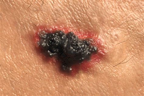 Skin Cancer Symptoms: How to Check for Moles | Reader’s Digest