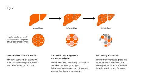 Liver fibrosis: Patients can be at risk of death even without exhibiting symptoms