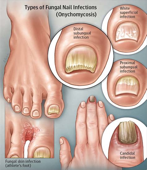 Foot fungus types pictures - Awesome Nail