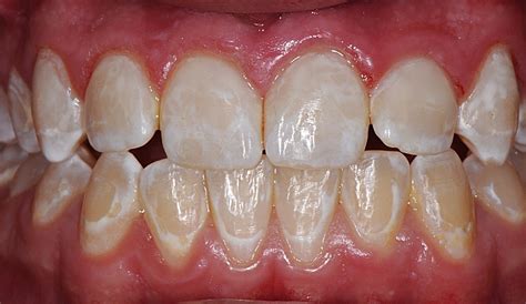 Tooth Decay Treatment Before And After