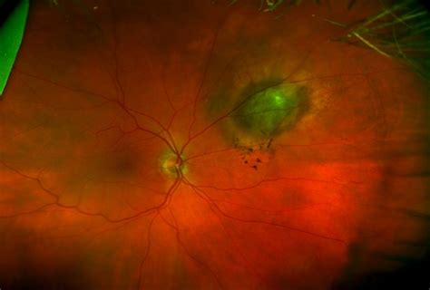 Choroidal Nevus[004] - Retina Image Bank