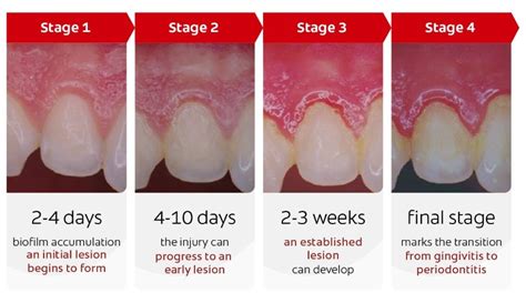 Stages Of Gingivitis