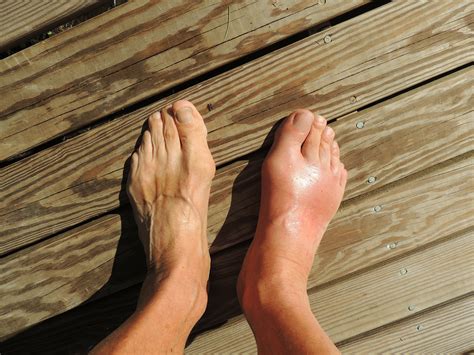 8 Dangerous Medical Conditions Linked To Swollen Feet - David Avocado Wolfe