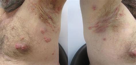 View 30 Hs Skin Disease Pictures - mensesiepics