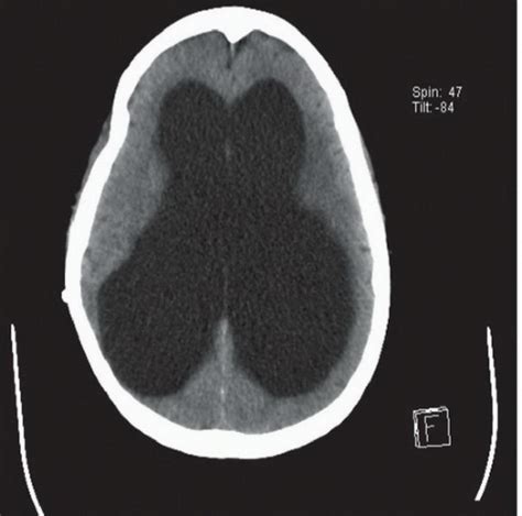 Ventriculoperitoneal Shunt Malfunction | Radiology Key