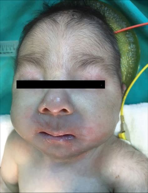 Trisomy 18, Edwards syndrome causes, symptoms, life expectancy & treatment